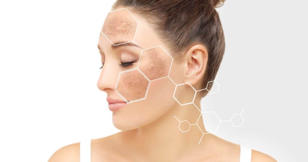 Age Spots/Dark Spots/Skin Spots/Liver Spots | Skynn MD in Holly Springs, NC