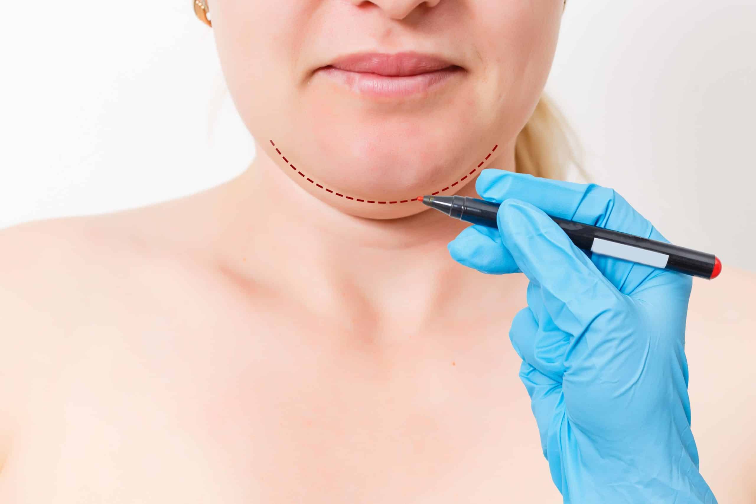 Woman Getting Double Chin Treatment | Skynn MD in Holly Springs, NC