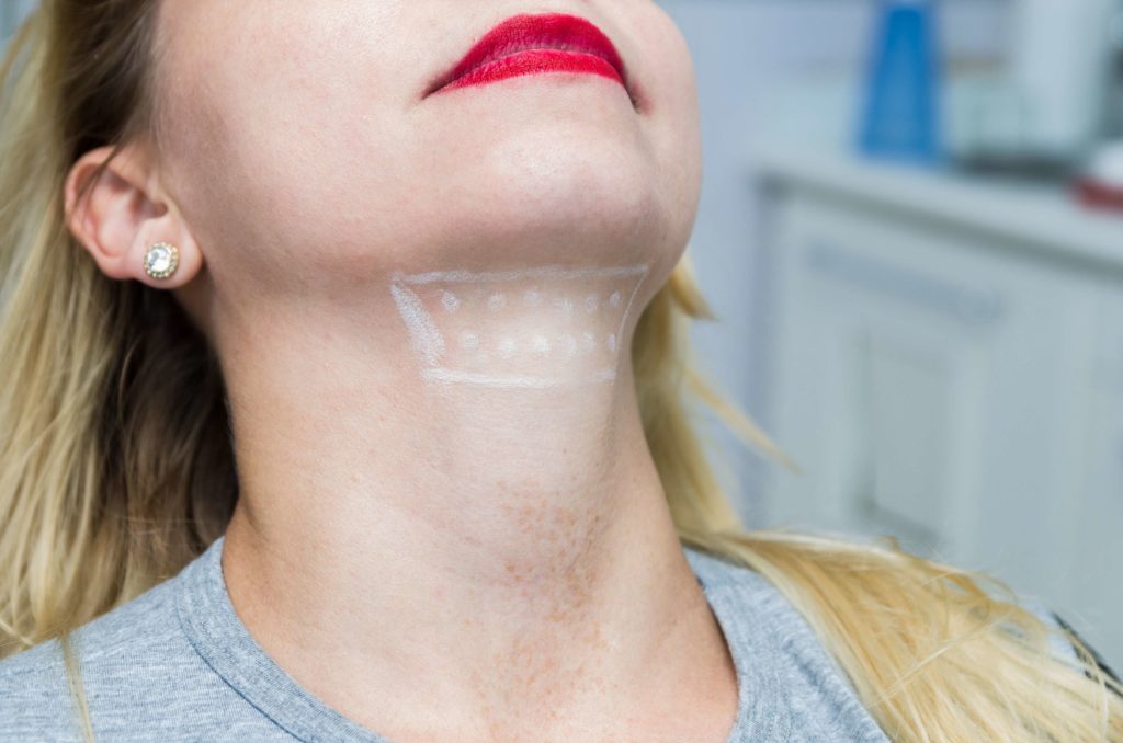Woman Getting Facial Shape Loss Treatment | Skynn MD in Holly Springs, NC