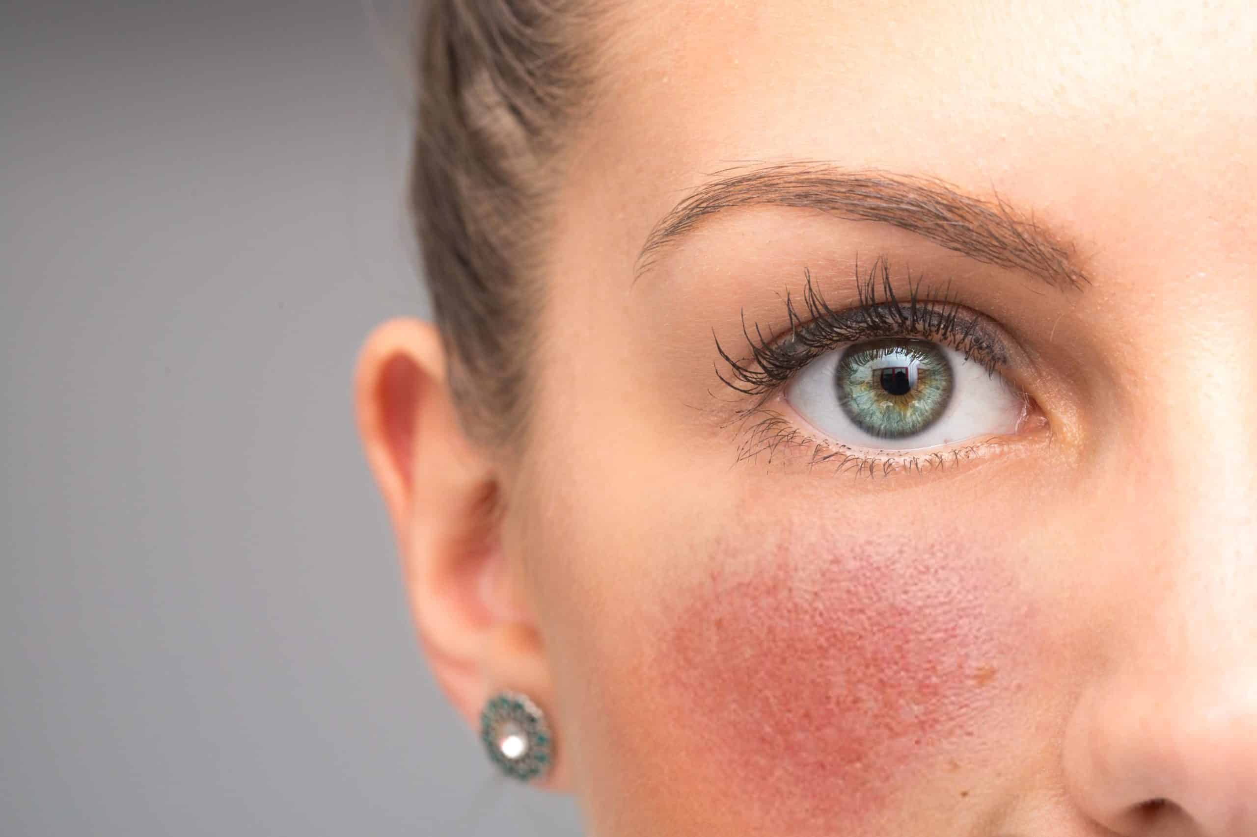 Close-up of Rosacea on Woman's Cheek | Skynn MD in Holly Springs, NC