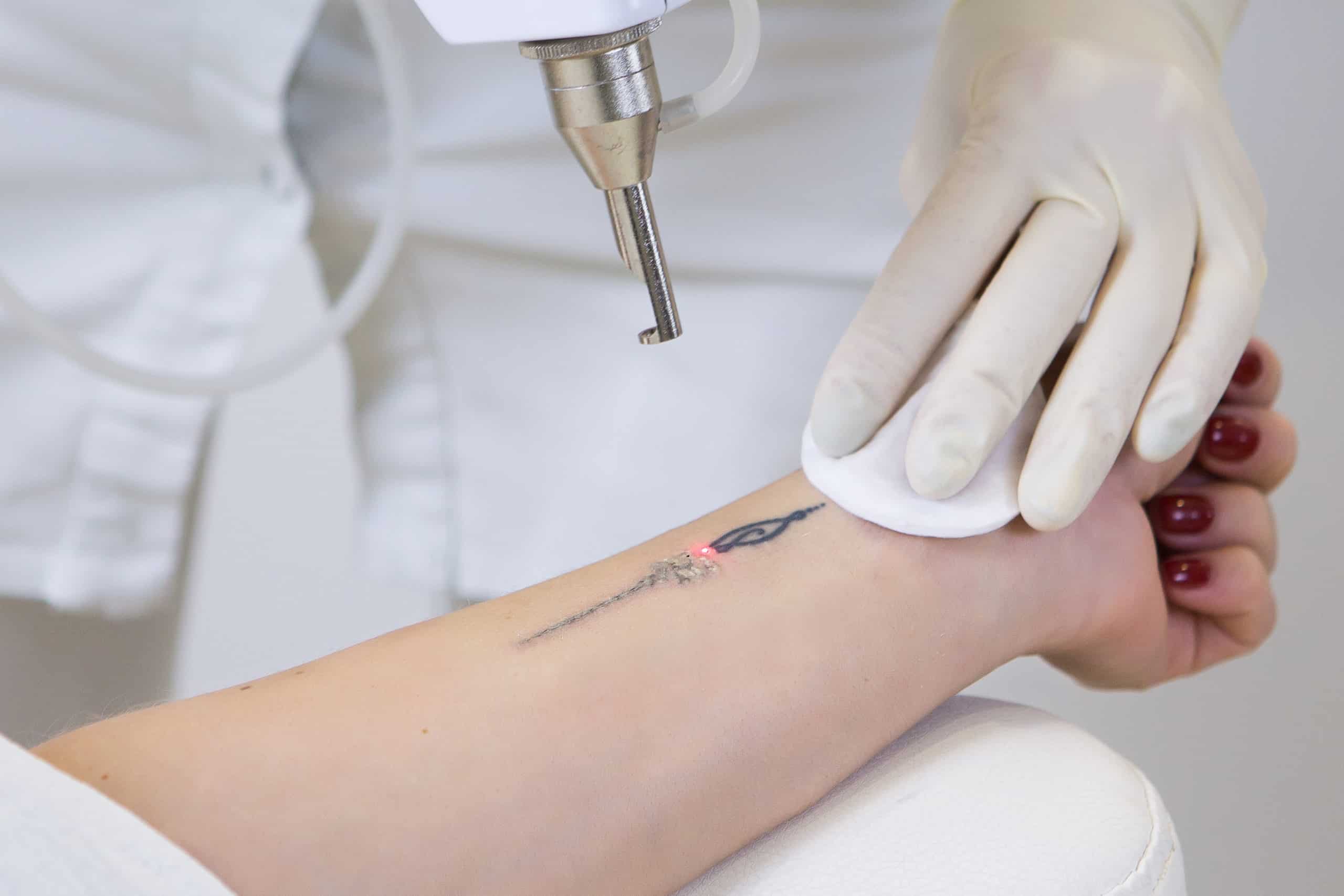 Close-up of laser tattoo removal from woman hand | Skynn MD in Holly Springs, NC