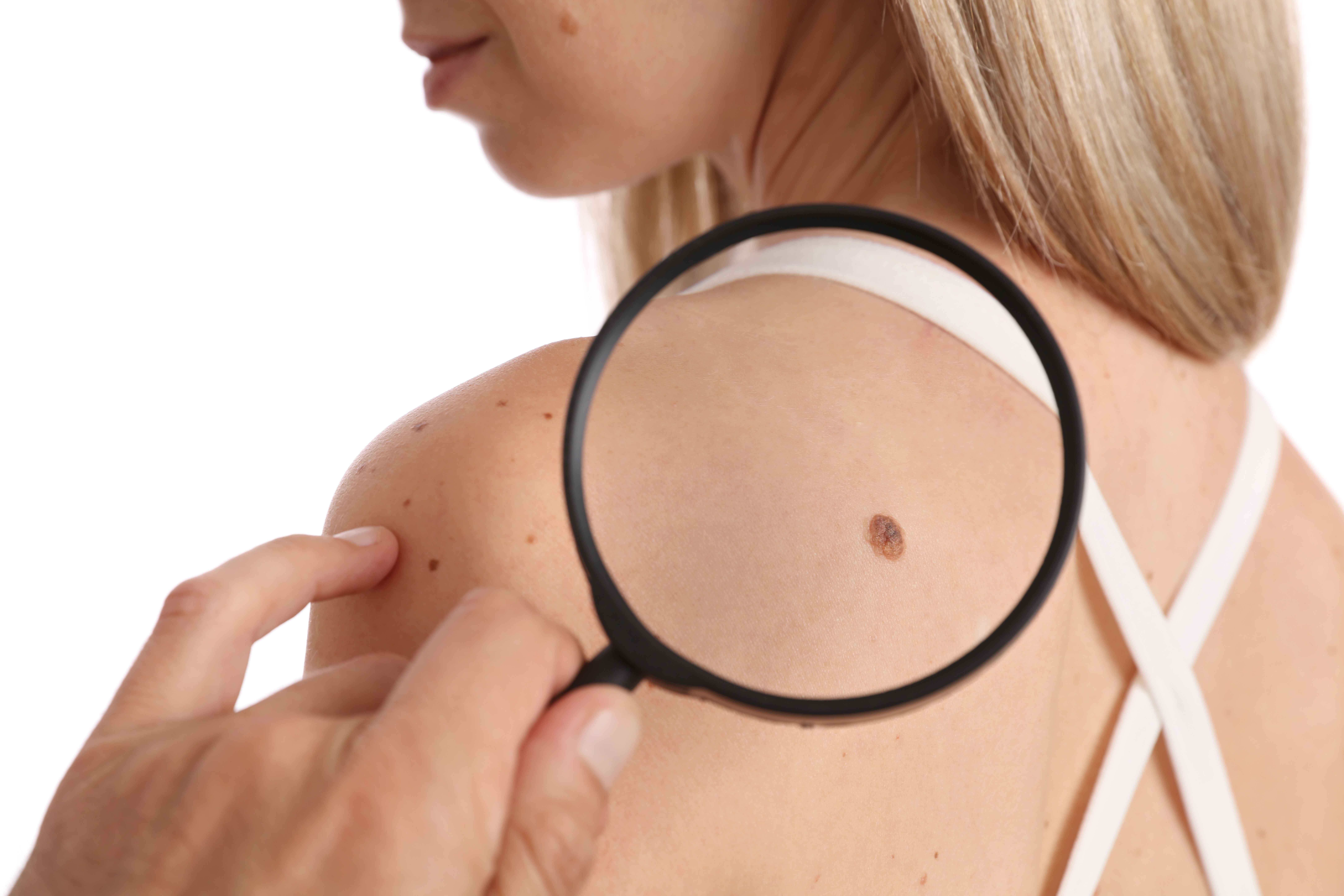 A Woman searching skin tag by Lens | Skin Tags Service | Skynn MD in Holly Springs, NC