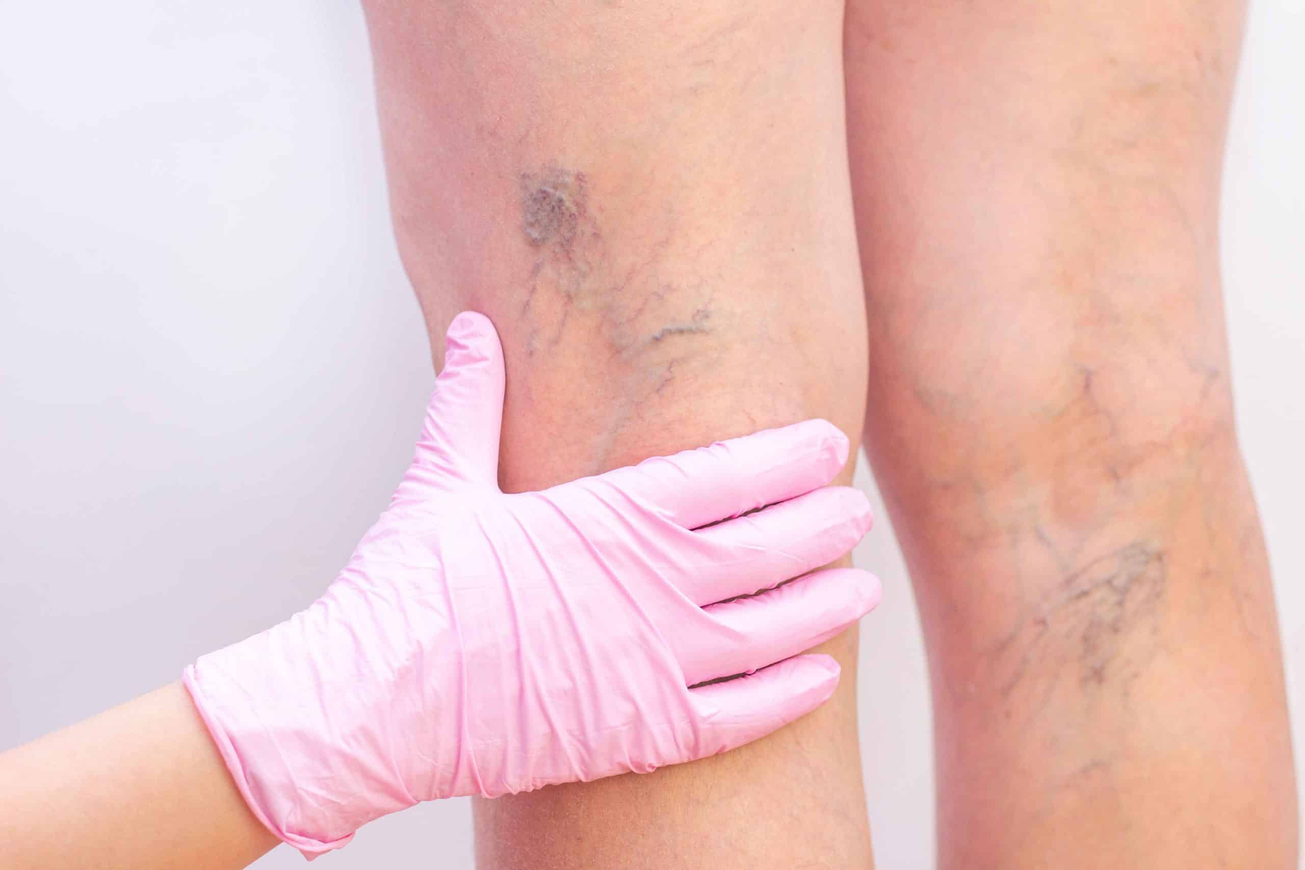 Doctor checking spider veins in a leg | Spider Veins treatment | Skynn MD in Holly Springs, NC