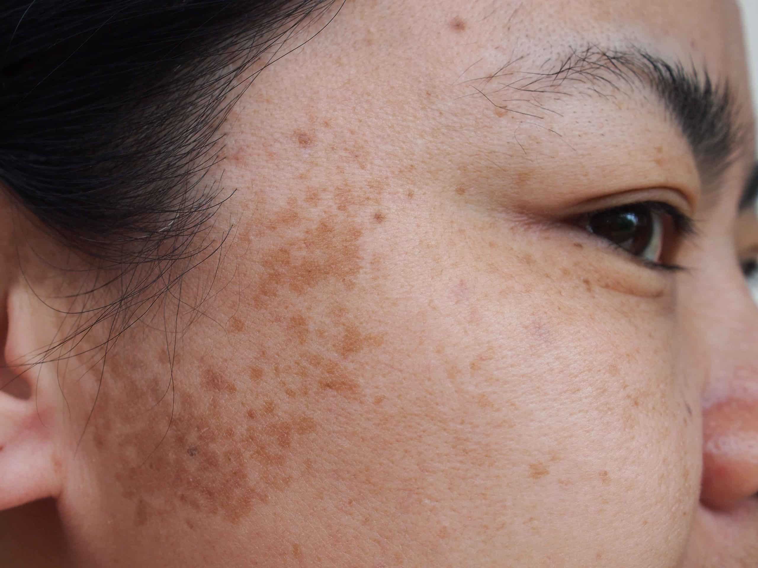 A Woman Cheek with sun spots | Sun Spots treatment | Skynn MD in Holly Springs, NC