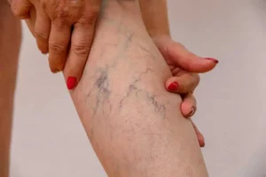 Spider Vein Removal by Skynn MD PLLC in Holly Springs, NC