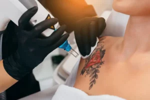 Laser Tattoo Removal by Skynn MD PLLC in Holly Springs, NC