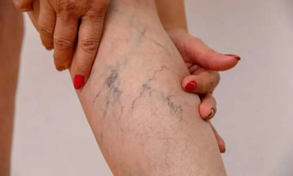 Spider Vein Removal by Skynn MD PLLC in Holly Springs, NC