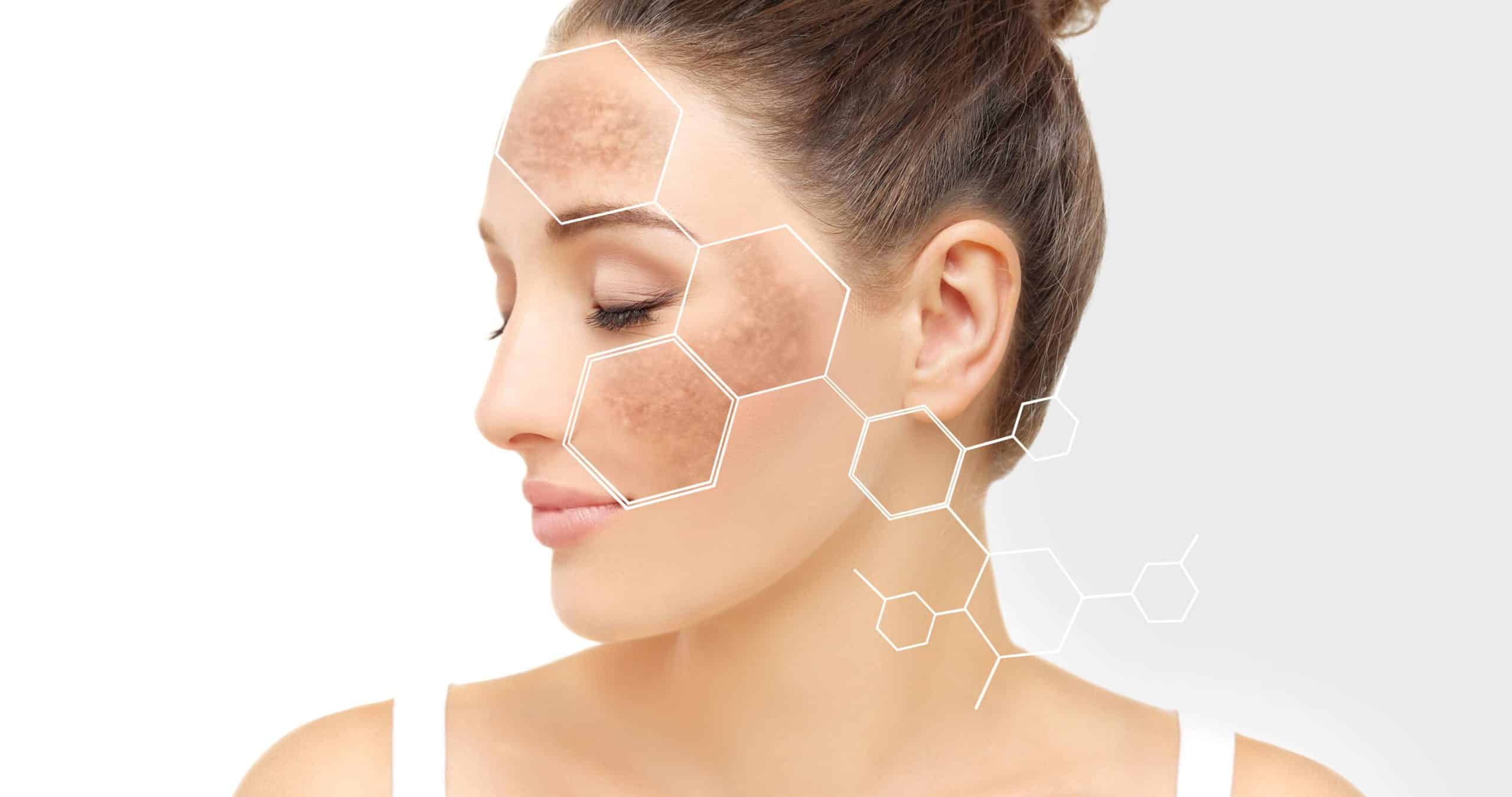 Age Spots/Dark Spots/Skin Spots/Liver Spots | Skynn MD in Holly Springs, NC