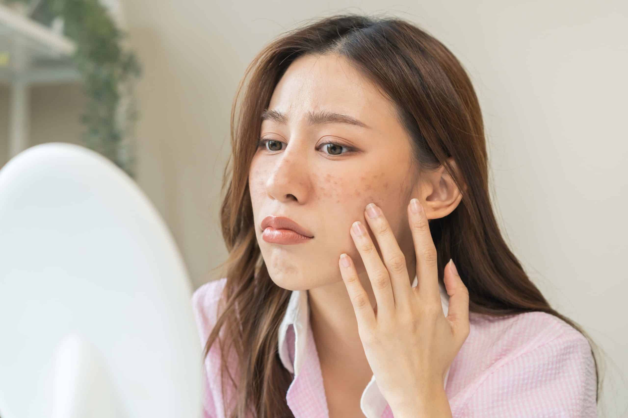 Tensed Woman Examine Melasma on her Cheeks in Mirror | Skynn MD in Holly Springs, NC