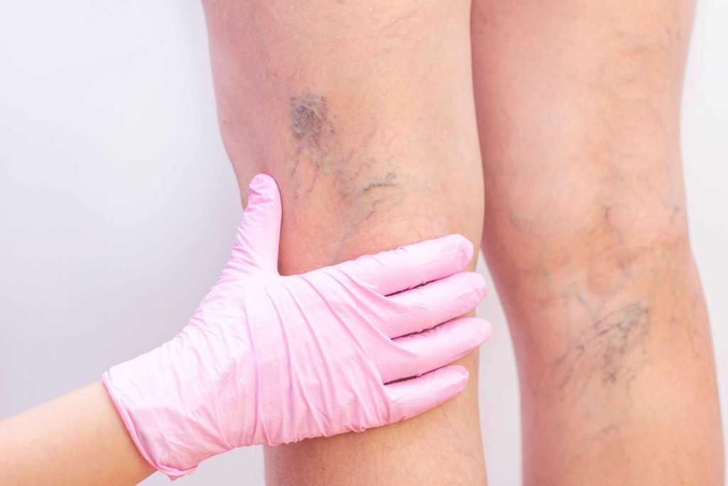 Advanced Spider Vein Treatment in Holly Spring, NC: SKYNN MD