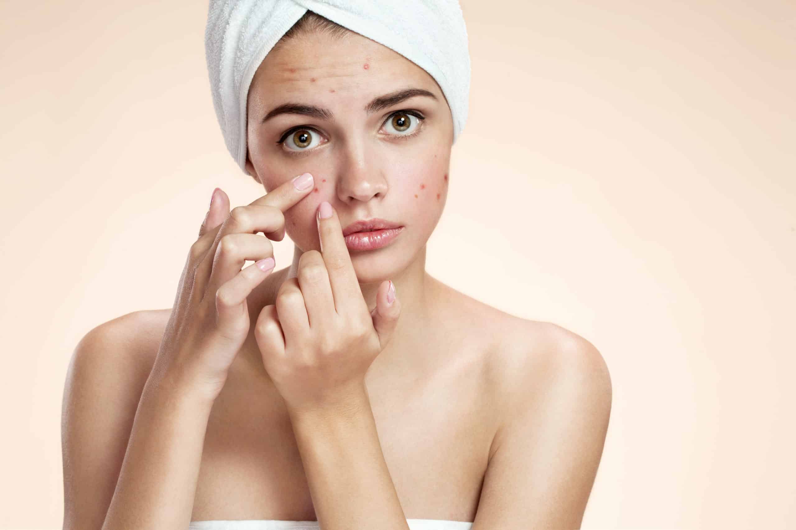 Get Active Acne Removal in Holly Springs, NC | Skynn MD