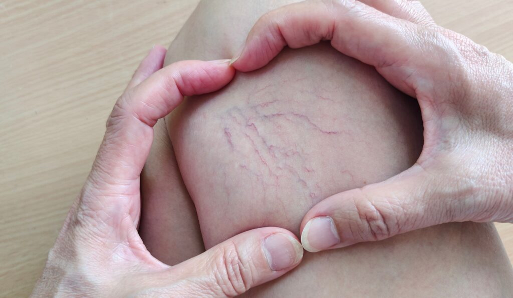 Laser Spider Vein Removal in Holly Springs, NC | SKYNN MD