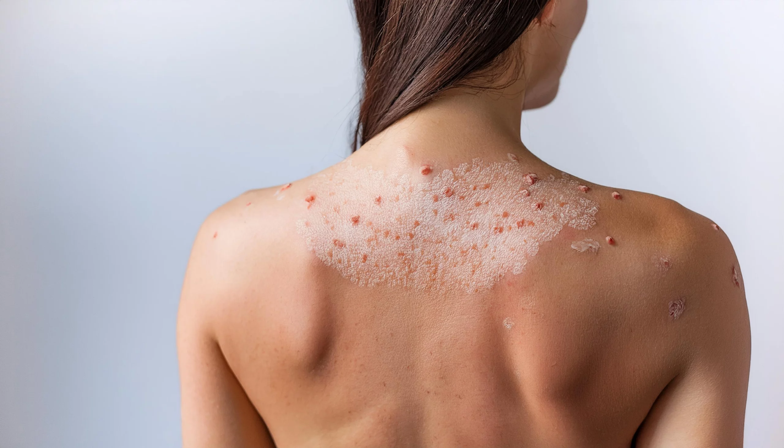 A woman with a rash on her back, diminishes acne scars, and hyperpigmentation in Holly Springs, NC