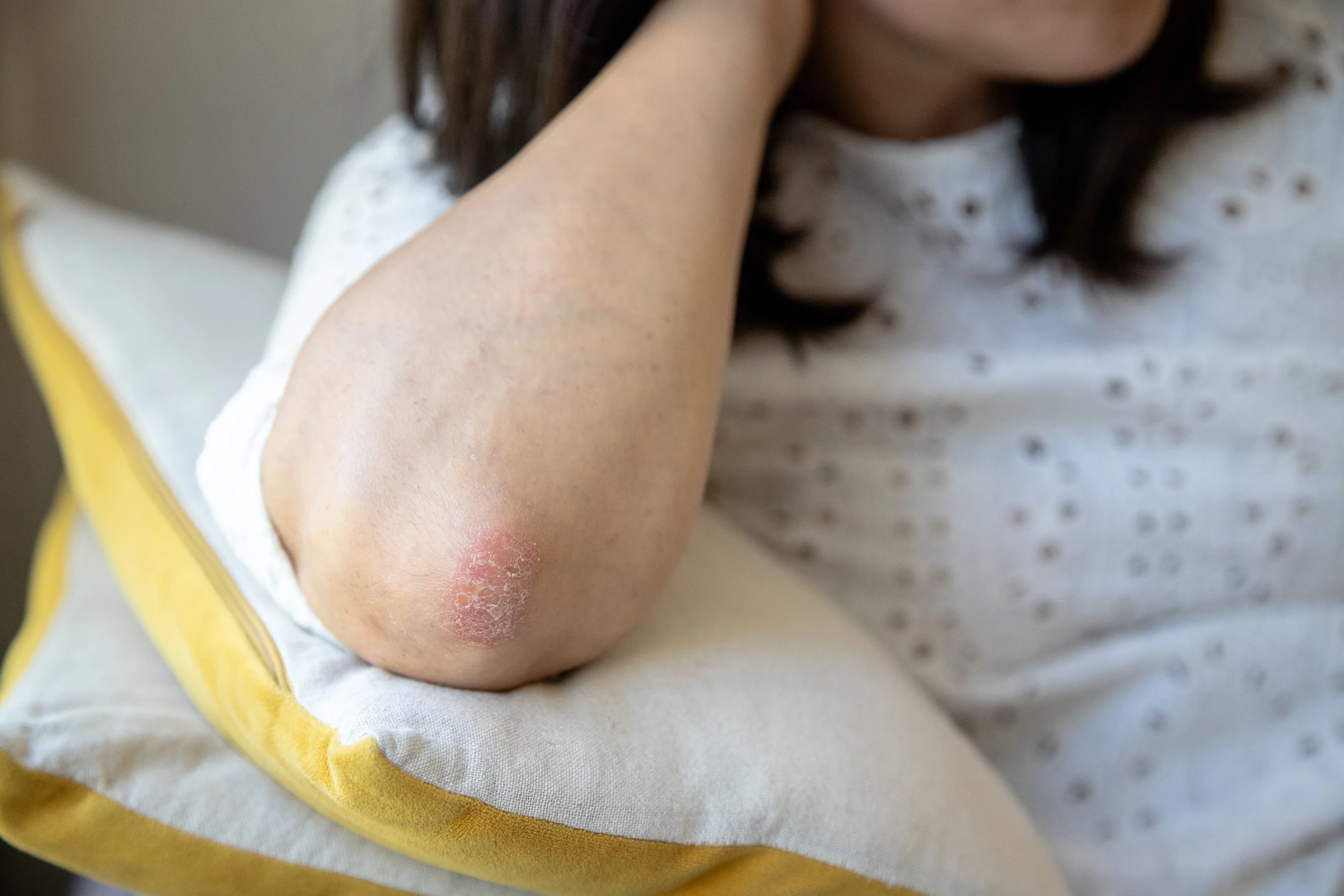 a person with a sore on their elbow Softens rough patches and dry skin in Holly Springs, NC