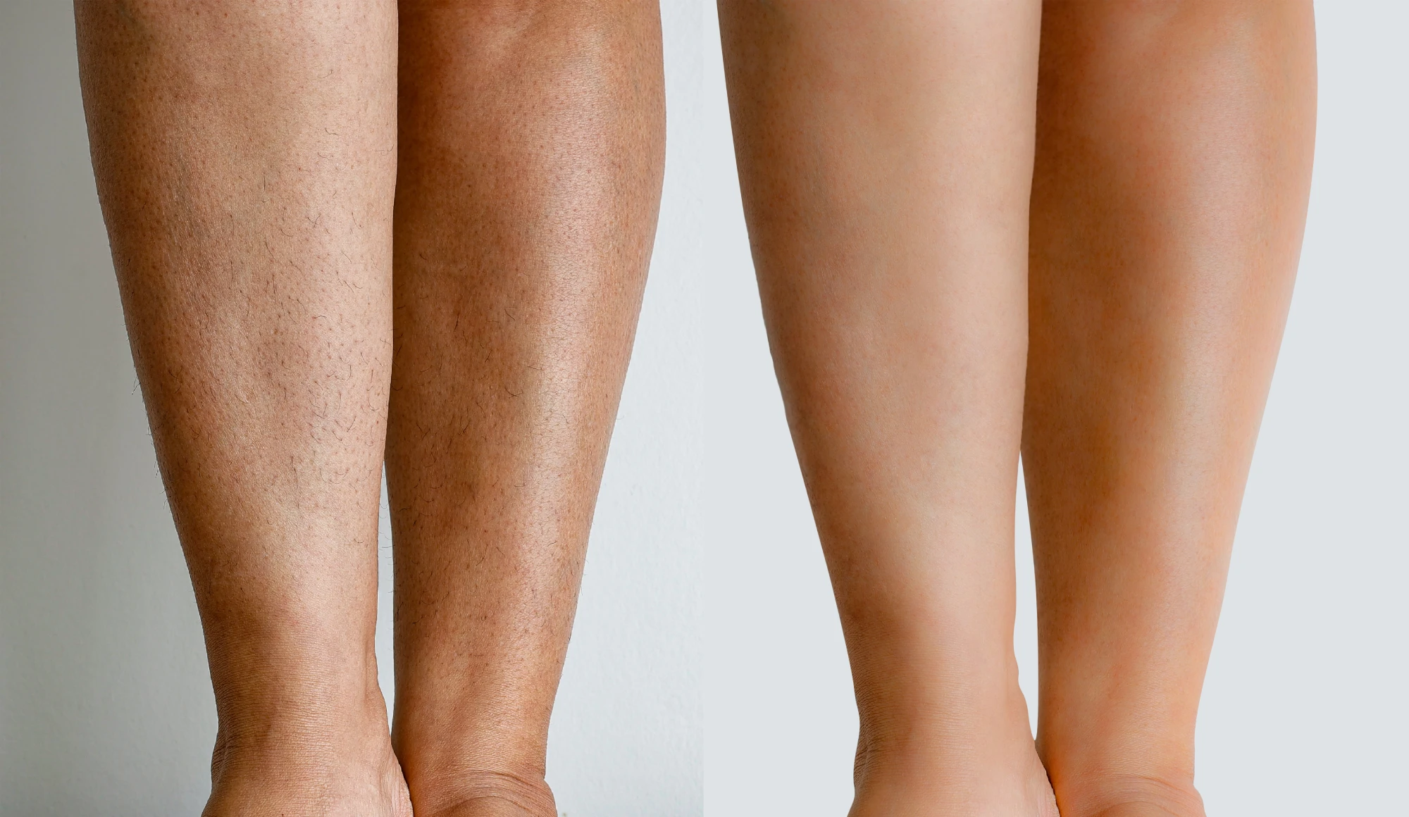 a close-up of a person's legs, Laser Hair Removal for Legs in Holly Springs, NC